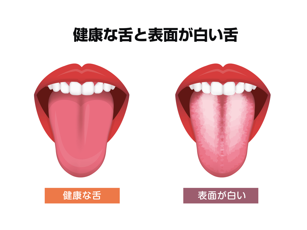 舌にある白いものが口臭の原因？取り方のポイントやよくある疑問 | 口臭 | お口の健康コラム Byクルクリン | クルクリンPGガード ...